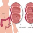 Definiţie şi cauze Cancerul de colon este o afecţiune tumoralã a ­colonului (intestinului gros). Cancerul rectal afecteazã ultimii centimetri ai colonului, astfel încât împreunã cele doua afecţiuni poartã ­denumirea de […]