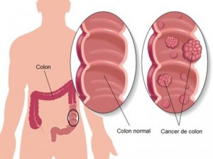 cancer-de-colon1