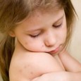 Dr. Carollina RADU Scarlatina este o boală in­fecțioasă eruptivă deosebit de severă, specifică copilăriei, mai frecvent sub vârsta de 10 ani, determinată de variate tipuri de streptococi beta-hemolitici de grup […]