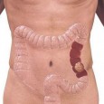Dr. Carollina RADU Cancerul de colon este o afecţiune care presupune apari­ţia unei proliferări celulare la nivelul intestinului gros, partea inferioară a tubului digestiv. Cancerul rectal este situat la nivelul […]