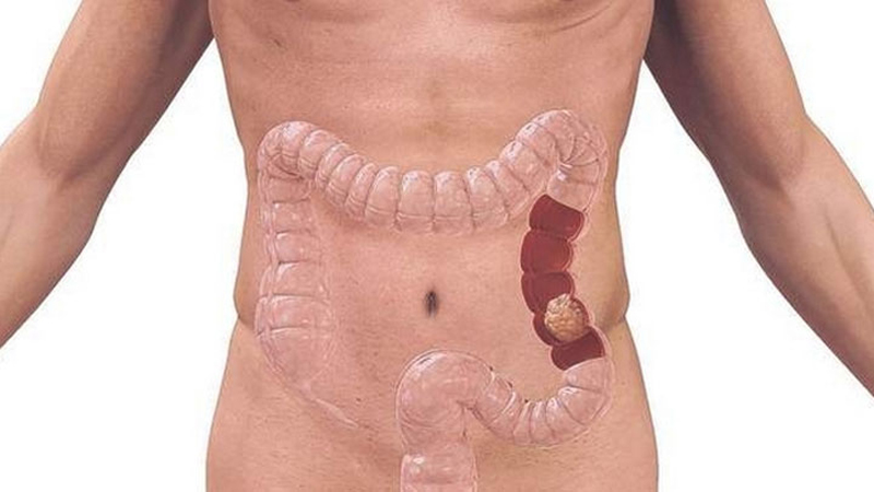 Semne și simptome ale cancerului de colon la bărbați