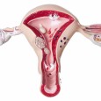 Dr. Carollina RADU   SOP – Sindromul ovarului po­­lichistic reprezintă una din afecţiunile endocrine cele mai frecvente, prevalenţa sa fiind de aproximativ 6% din po­pulaţia feminină. SOP este o afecţiune […]
